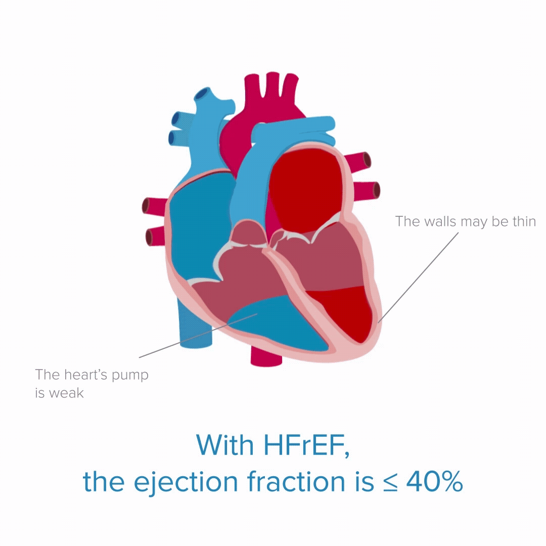Animated illustration of heart failure with reduced ejection fraction (HFrEF), showing a weak pump and possibly thin walls, with ejection fraction‚ less than or equal to 40%.