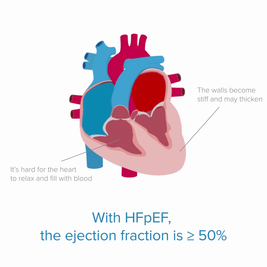 Diagram of a heart showing HFpEF condition. Labels indicate wall stiffness, potential thickening, and ejection fraction being 50% or greater.