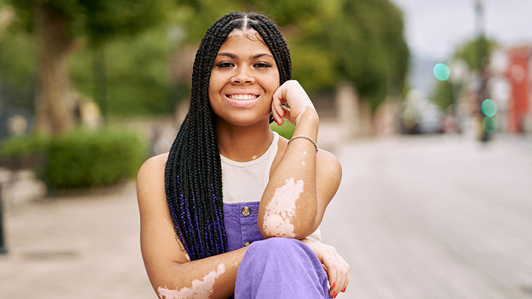 Smiling young woman with vitiligo sitting outdoors on a pedestrian street.