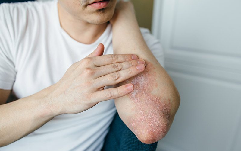 A person in a white shirt is applying lotion to their elbow, showing signs of dry skin or irritation.