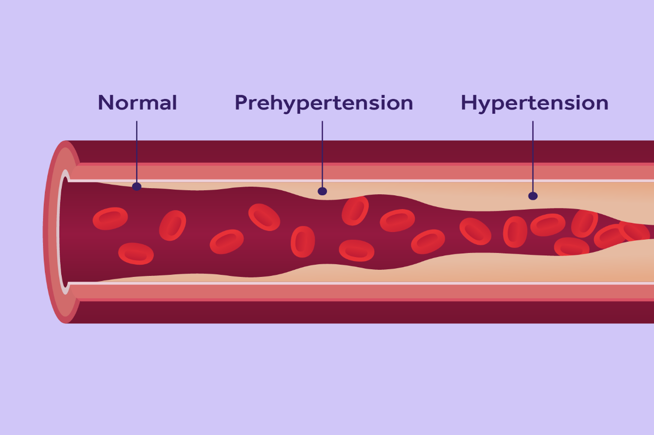 Illustration of a blood vessel showing what it looks like with normal, prehypertension and hypertension.