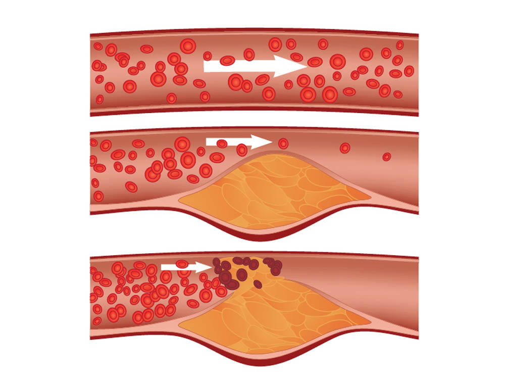 Diagram showing artery sections: normal blood flow, partial blockage with plaque buildup, and significant blockage with reduced blood flow.